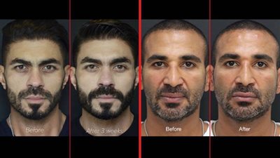 بعد خالد سليم .. رواد السوشيال ميديا يهاجمون أحمد سعد بسبب عمليات التجميل