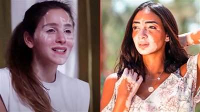 لُجينة صلاح : جميلة عوض نقلت قصتي مع البهاق بواقعية في حكاية لازم أعيش