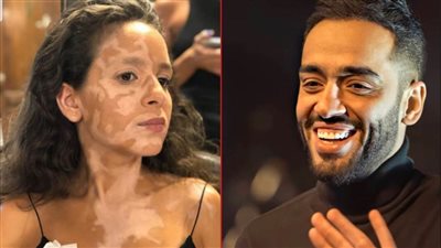 رامي جمال : مرض البهاق أقسى على البنات وسعيد بتناول جميلة عوض للفكرة