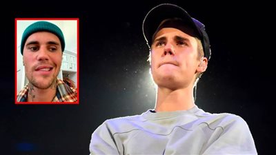 تفاصيل متلازمة رامزي هانت التي أصابت جاستن بيبر بالشلل 